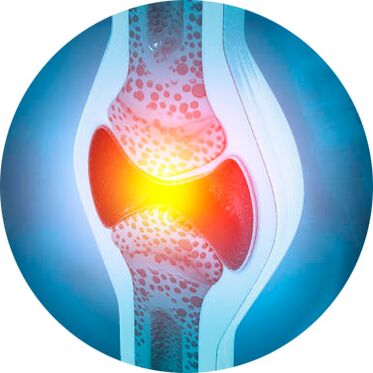 Processus de restauration des articulations avec le gel Icexin.