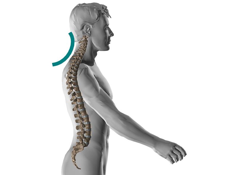 Ostéochondrose cervicale de la colonne vertébrale, qui provoque de nombreux symptômes désagréables.