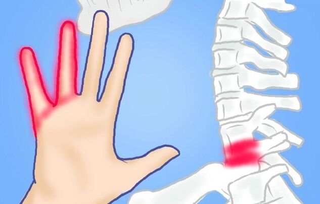Nerfs pincés comme cause de douleurs lombaires.