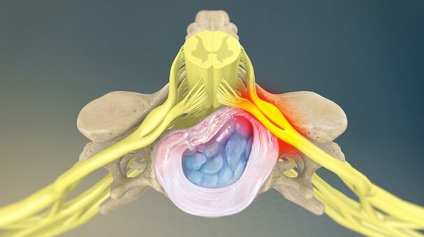 le syndrome radiculaire comme cause de lombalgie
